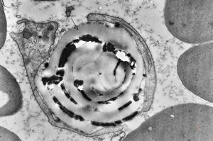 M,43y. | fungi in blood (Candida v.s.) - mycoseption